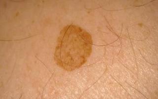 Возрастная пигментация кожи: причины, лечение, профилактика Травмы кожи, в том числе солнечные ожоги
